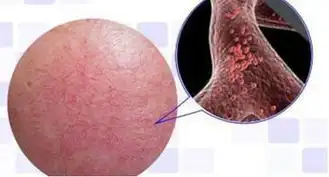 如何有效改善面部红血丝从护肤到医美给你讲通透