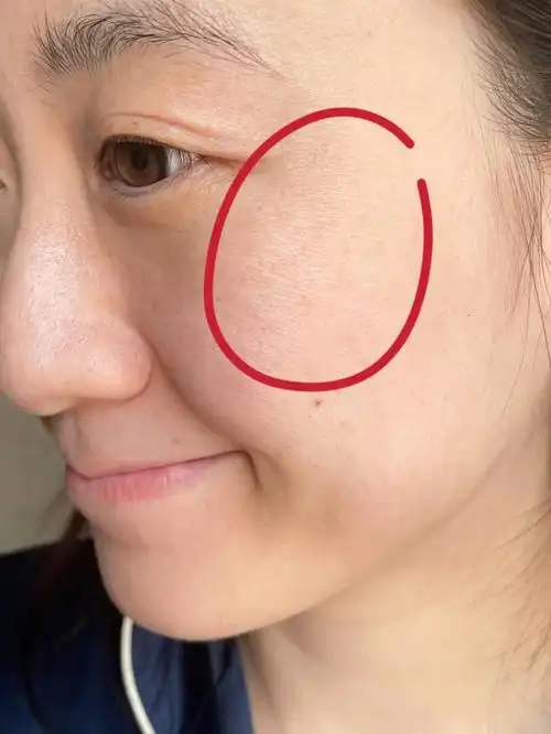 笑起来脸颊这种向下的细纹是什么?怎么搞?