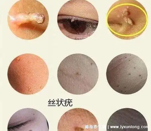 男性hpv感染图片初期症状各种形态的可怕疣体遍布全身