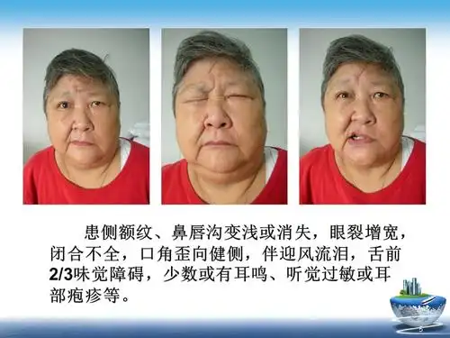 医学课件面神经麻痹课件ppt