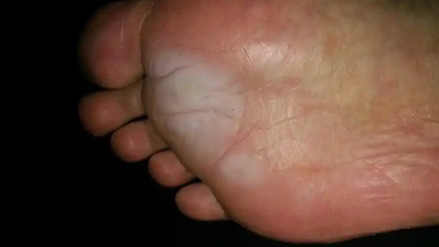 今天穿运动鞋,站了一天,脚底就泛白,跟水泡过了一样.