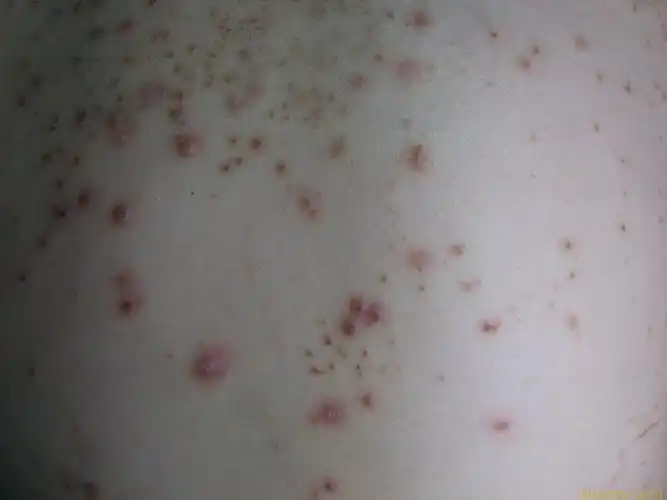 看图识病马拉色菌毛囊炎三天治愈