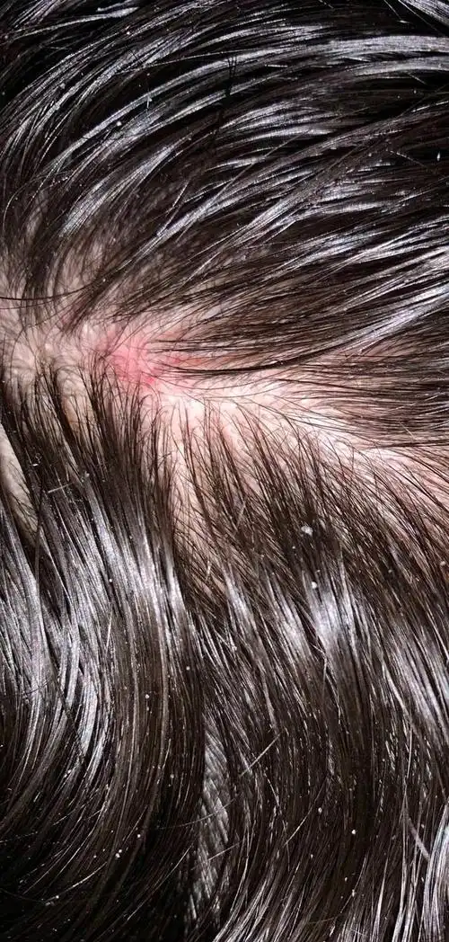 为什么头皮总长脓包和疙瘩这4个原因你知道吗