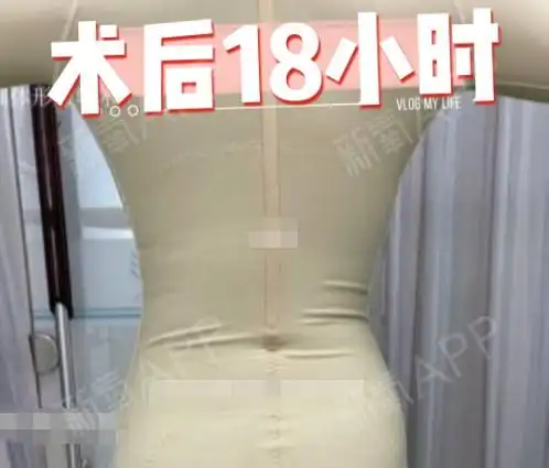 肚子吸脂15天恢复图,我做腰腹环吸亲身经历术后即刻_圈子-新氧美容