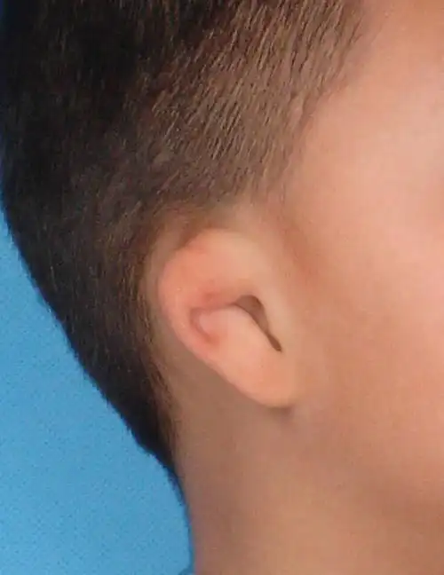 各式各样的耳廓畸形-杯状耳_耳部整形_耳部整形症状 - 好大夫在线