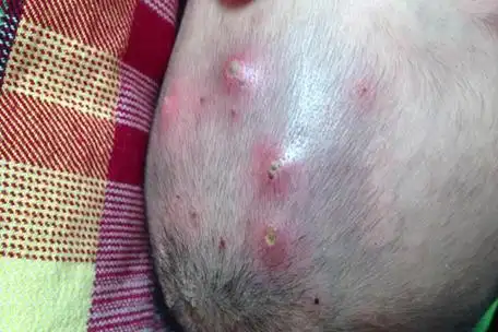 毛囊炎的常见症状有哪些?_广州荔湾区肤康皮肤科医院