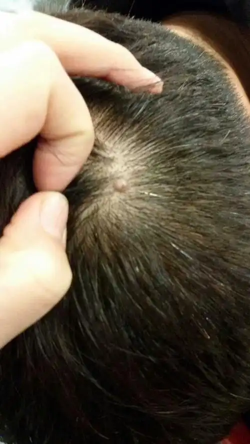 头部上端类似肉瘤