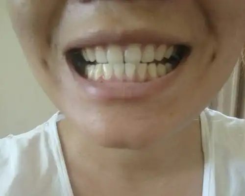 尖牙:牙齿长的尖,精打又细算尖牙的人,做事精打细算,设想周到,但耐力