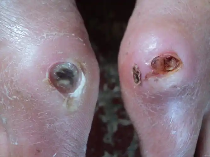 慢性皮肤溃疡就不愈合