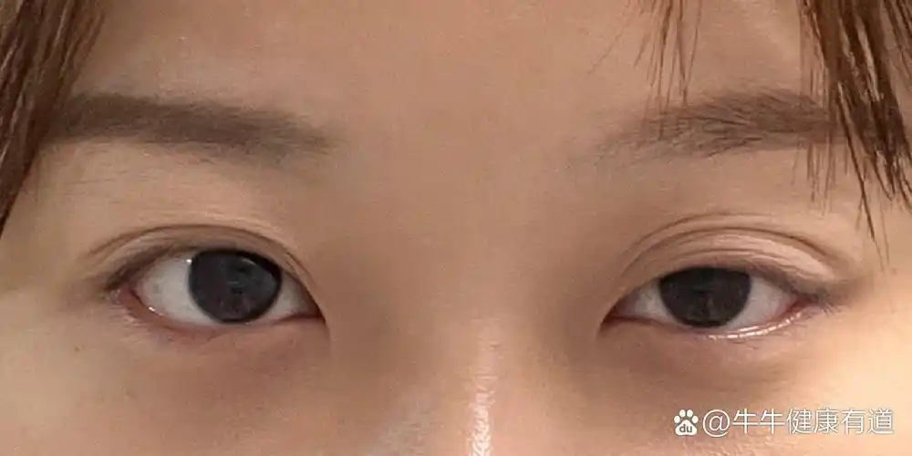 眼肌型重症肌无力病友求助 去年1月份确诊的眼肌型重症肌无力,只有