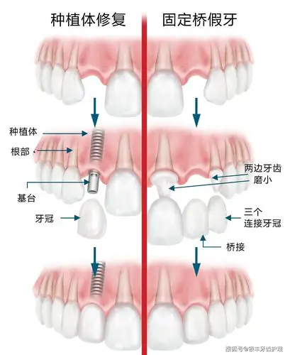 种植牙的利与弊看完你就可以放心种牙了