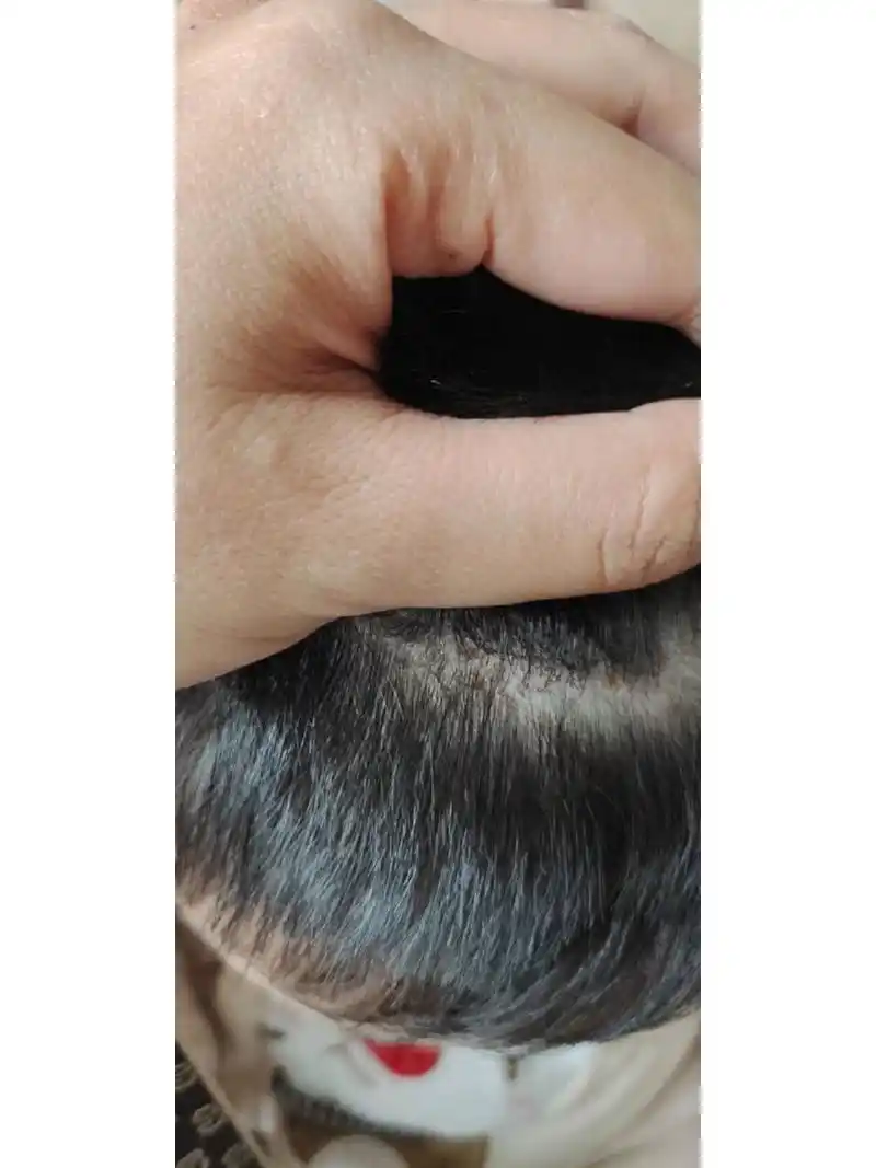 宝宝头顶上有一片黄色的结痂 今天才注意到头发里面有黄色结痂 不知道