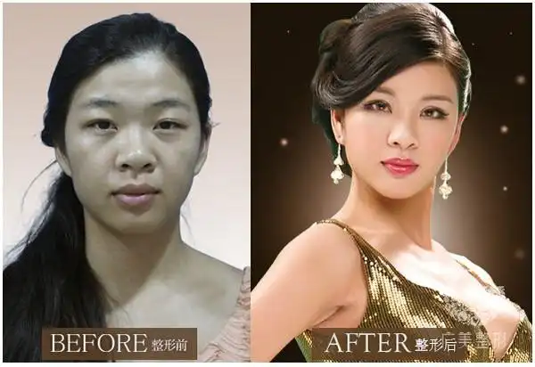张秀珍整形前后对比