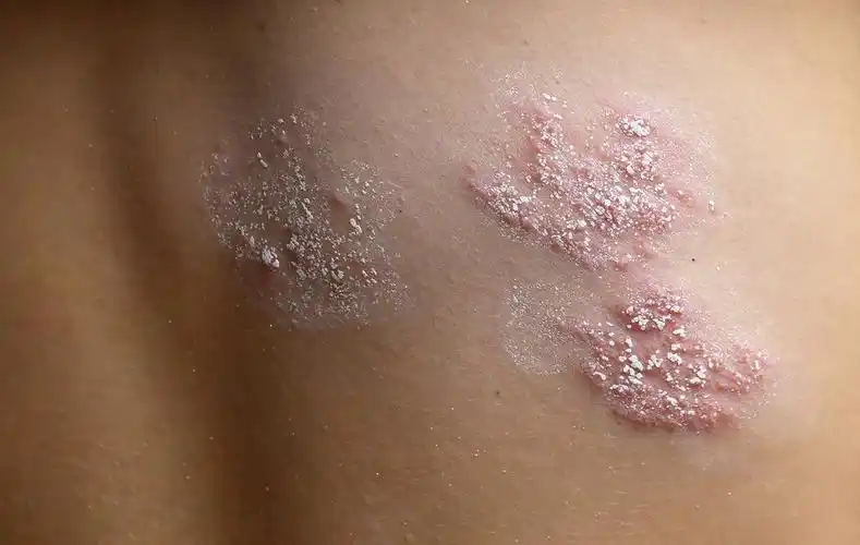 男子自知艾滋病感染仍嫖男娼,如何识别对方是否是艾滋病患者 - 春雨