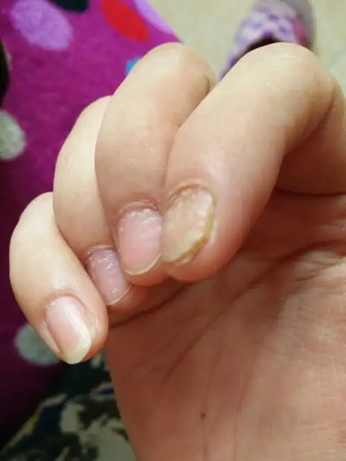 [婆婆妈妈]有没有曾经灰指甲经历的宝妈或亲戚朋友,帮帮忙,说说是怎么