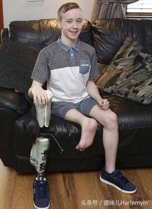 首个倒装右腿的人类,虽然无奈,但走的还挺快!