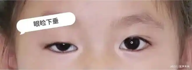 重症肌无力——为何让年轻的生命感觉如此无力?