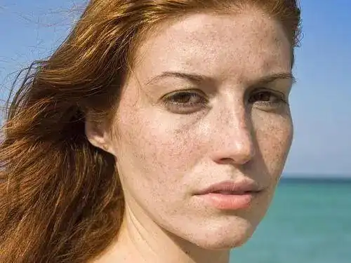 才20岁脸上就长斑了怎么解决