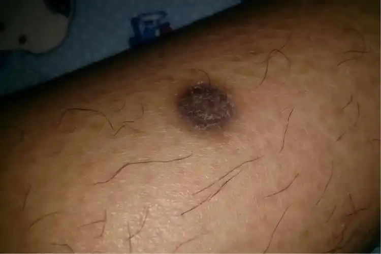 广州医科大学附属第一医院「三级甲等」 皮肤科概述腿上长了黑痂会