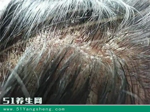 4,头癣:有一种头癣叫白癣,可以引起头皮屑增多,同时伴有脱发,是真菌
