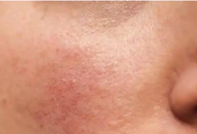 原创皮肤屏障受损怎么办护肤做好这几步是关键坚持才有效哦