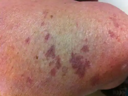 图文盘点肢端分布的血管性皮肤病