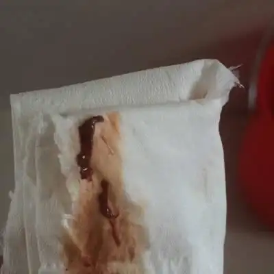 孕13周,前三天去检查宝宝正常,就是一直都有积血,今天排出血块,这样