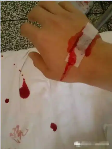 静脉输液怎样扎针才不痛?怎样拔针才不疼?_血管