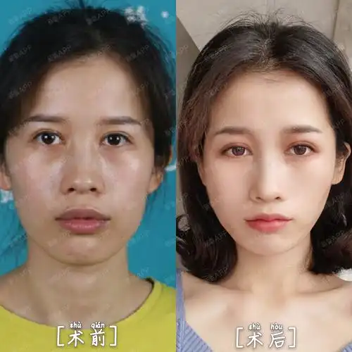 嘴唇太厚影响面部轮廓的_圈子-新氧美容整形