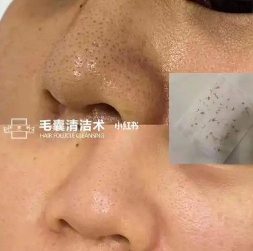顾客毛囊清洁 对比图  一次让你看到效果