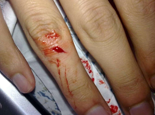 手出血的图片61