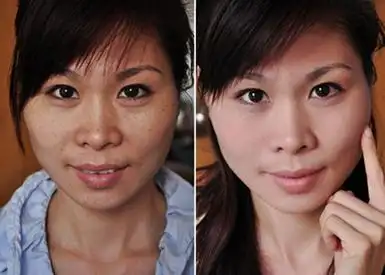 但是缺点是需要持续多次注射,而且停止注射的话美白效果也随之消失