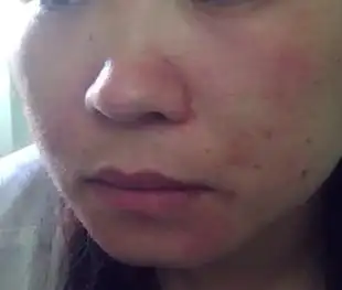 在qq网上买化妆品引起皮肤过敏 红肿痒出了医疗事故 商家不赔付医药费