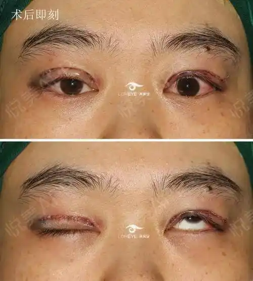 上睑下垂双眼皮修复案例15年8月3日顾客术后恢复展示