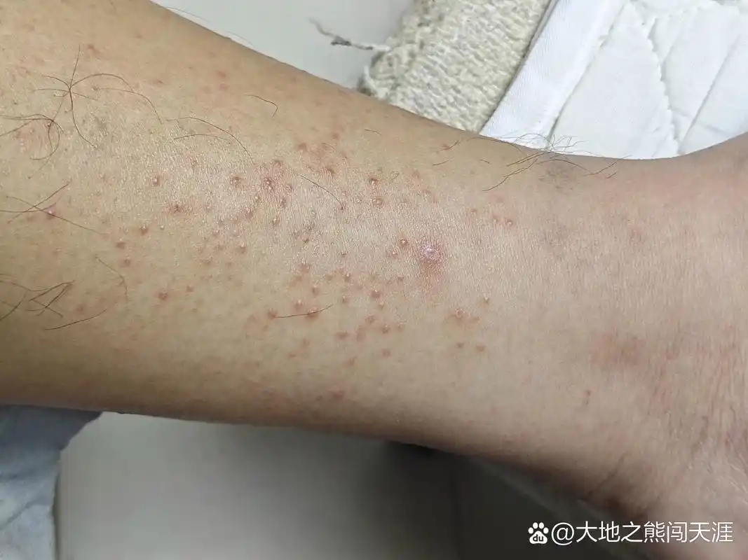 小腿内侧  有点痒  一挠更痒   是湿疹还是什么?怎么治疗