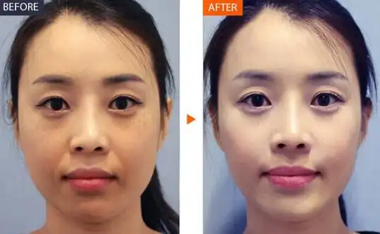 水光针会有依赖性水光针常见的6个误解