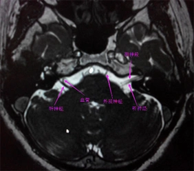 三叉神经(痛),面神经面肌痉挛血管磁共振成像mrta技术 - 好大夫在线
