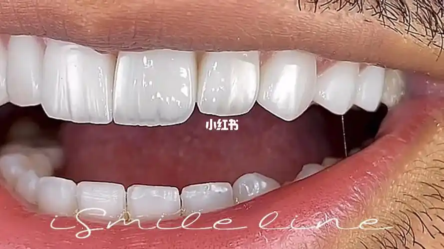 超薄瓷贴面_牙齿贴面_美妆_医美整形