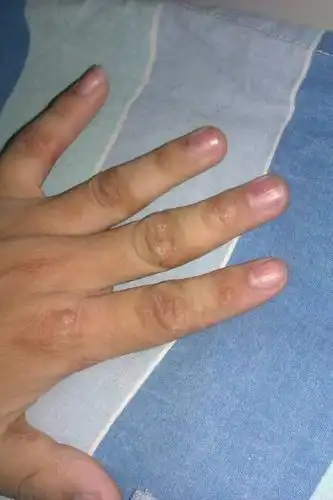 手指和脚指的关节部位特别痒!尤其是晚上