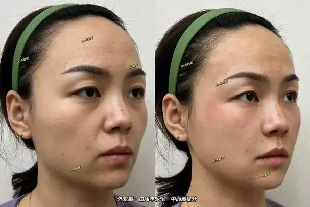 泪沟明显,细纹增多,皮肤缺水   -来支玻尿酸这些通通都能做到丰额头