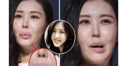 脂肪填充多长时间可以消肿?