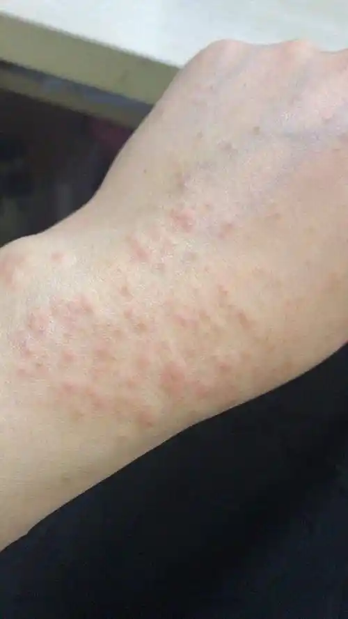 1 湿疹是分为急性和慢性的,急性的是因为接触造成的过敏,比如说对洗