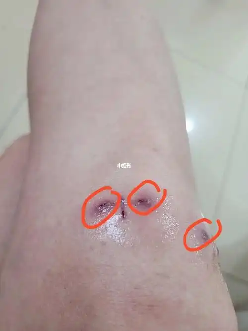 半月板撕裂术后27天线结反应