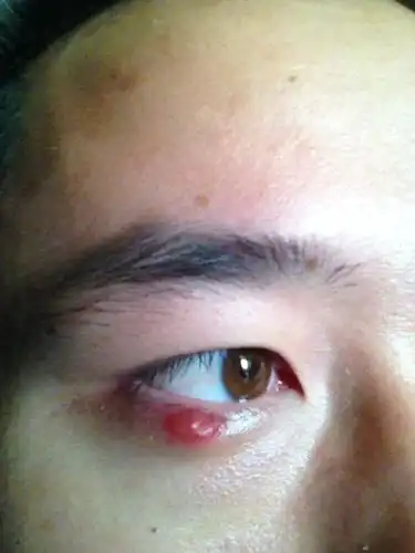 眼下皮肿了一个月了,医生说是麦粒肿,买了金霉素眼膏和吃消炎药都不