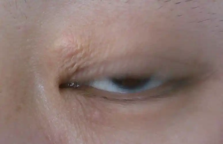 上眼皮长了一个疙瘩,有半年时间了