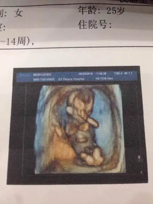 这才12周的彩超的,为什么脐带下面还有什么东西,正常的吗?