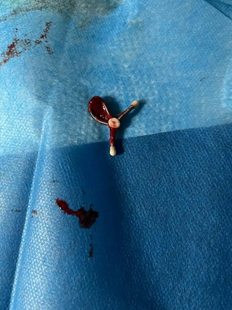 图文伙伴计划 熬过生孩子的痛,熬过上环的痛,最终逃不过取环 - 抖音