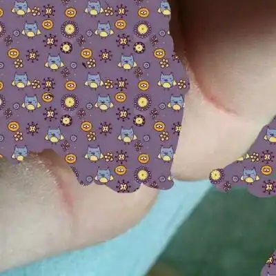 宝妈帮我看一下宝宝大腿两边内侧都是这样红红的是怎麼回事,需要注意