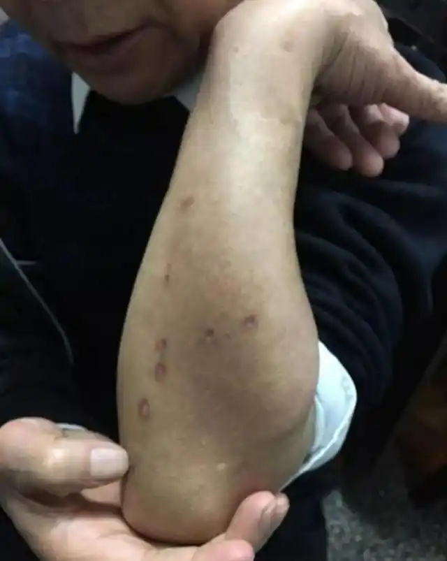 市民皮肤上长窟窿眼,原因系慢性肾衰竭早期指征