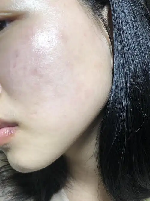 脸太干了涂了护肤品后发红发痒,有图慎入